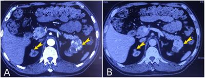 Renal cell carcinoma of different pathological types in bilateral native kidneys of a kidney transplant recipient: A case report and literature review